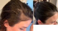25-34 year old woman treated with PRP & PRFM for Hair Loss