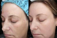 35-44 year old woman treated with Melasma Treatment (6 wks post)