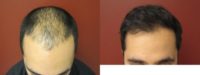 35-44 year old man treated with Artas Robotic Hair Transplant