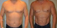 43 year old man treated with Vaser Liposuction