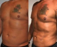 43 year old man treated with Vaser Liposuction