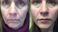 45-54 year old woman treated with Juvederm, Dermal Fillers