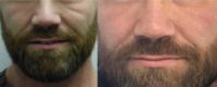 45-54 year old man treated with Vampire Facelift