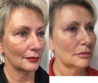 45-54 year old woman treated with Sculptra Aesthetic