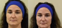 45-54 year old woman treated with Juvederm