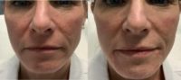 47 year old woman treated with Restylane Defyne in Lower Face