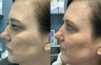 48 year old woman treated with Voluma in the Cheeks