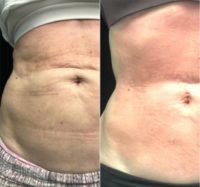 45-54 year old woman treated with Velashape
