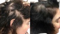 45-54 year old woman treated with Hair Loss Treatment