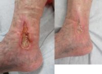 45-54 year old woman treated with Vein Treatment