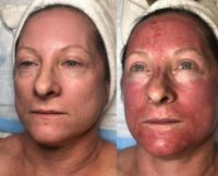 55-64 year old woman treated with Vampire Facelift