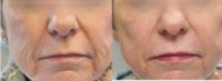 55-64 year old woman treated with ProFractional Laser