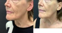 55-64 year old woman treated with Microneedling, Skin Rejuvenation