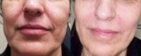 55-64 year old woman treated with Restylane Defyne