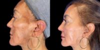 55-64 year old woman treated with Skin Rejuvenation, Skin Lightening