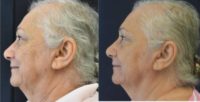 65-74 year old woman treated with Microneedling RF