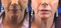 65-74 Year Old Woman Treated With Juvederm Voluma Lower Face