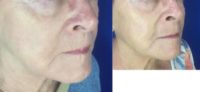 65-74 year old woman treated with Dermal Fillers
