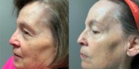 65-74 year old woman treated with Neo Laser