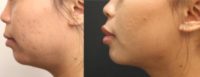 25-34 year old woman treated with Kybella