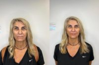 55-64 year old woman treated with Juvederm