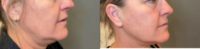 45-54 year old woman treated with Kybella