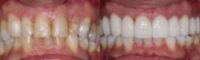 Discolord teeth treated with Dental Crown