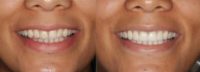 Porcelain Veneers and Teeth Whitening for a Beautiful Natural Smile