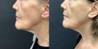 55-64 year old woman treated with Microneedling, Skin Rejuvenation