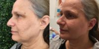 55-64 year old woman treated with Contour Thread Lift