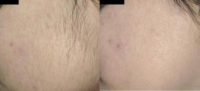 25-34 year old woman treated with Laser Hair Removal