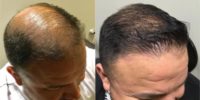35-44 year old woman treated with Hair Transplant