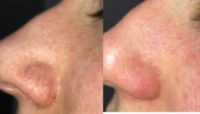 25-34 year old woman treated with Laser Treatment