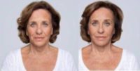Woman treated with Radiesse and Belotero