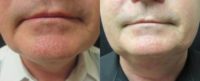 Laser Vein Removal of the Face