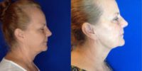 55-64 year old woman treated with AccuTite