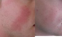 24 year old Male with Rosacea