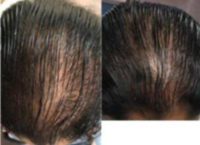 25-34 year old woman treated with Hair Loss Treatment
