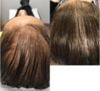 35-44 year old female treated with Hair Loss Treatment