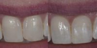 45-54 year old woman treated with Dental Bonding
