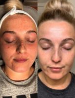 18-24 year old woman treated with Halo Laser
