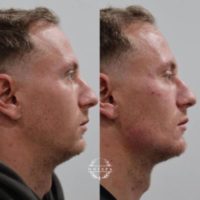 35-44 year old man treated with Bellafill