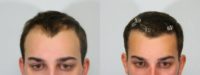 18-24 year old man treated with FUE Hair Transplant