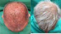 45-54 year old man treated with NeoGraft