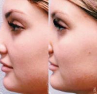 18-24 year old woman treated with Injectable Fillers to Chin