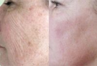 55-64 year old woman treated with Vi Peel