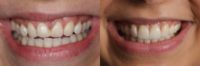 25-34 year old woman treated with Porcelain Veneers