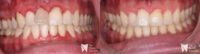 25-34 year old man treated with Internal Tooth Bleaching