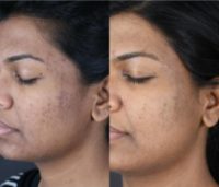 25-34 year old woman treated with Microneedling
