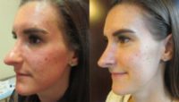 25-34 year old woman treated with Microneedling with Exosome Facial